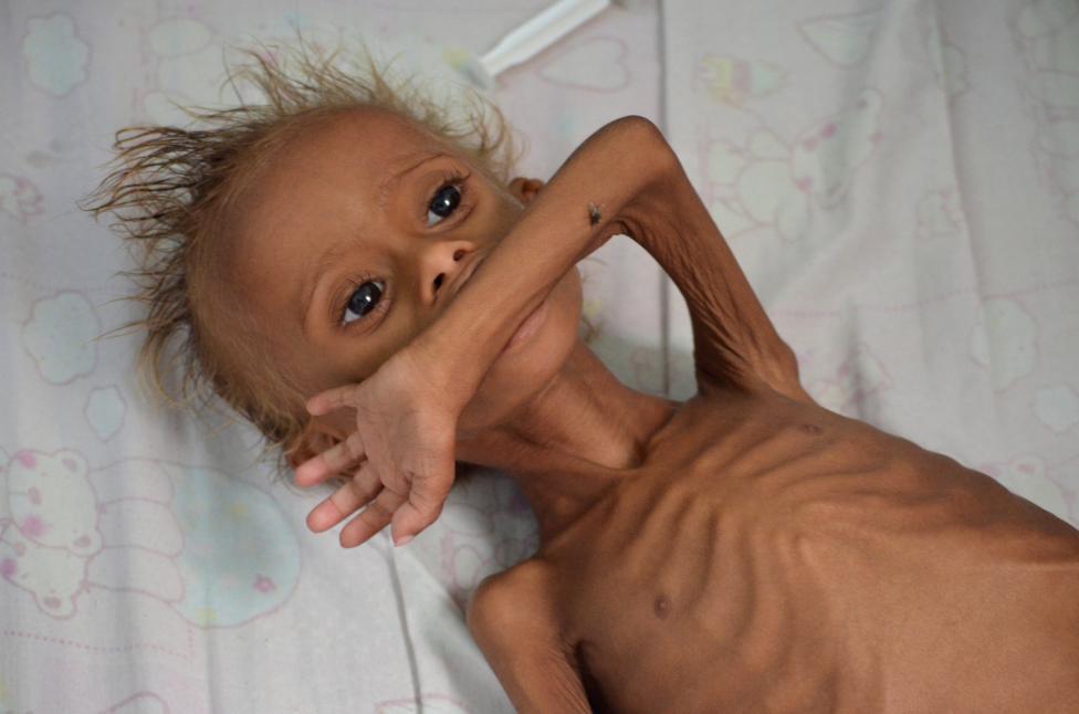 دست و پنجه نرم کردن کودکان یمنی با سوء‌تغذیه حاد! +تصاویر