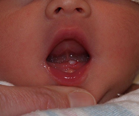 اگر نوزاد شما با دندان به دنیا آمده، بخوانید