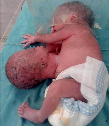 تولد نوزادی که روی شکم خود یک سر اضافی دارد +عکس