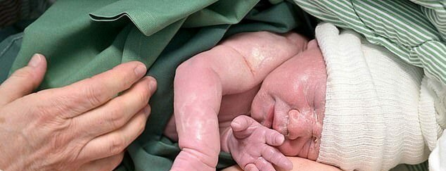 تولد نوزادی با توده ۳۰کیلوگرمی