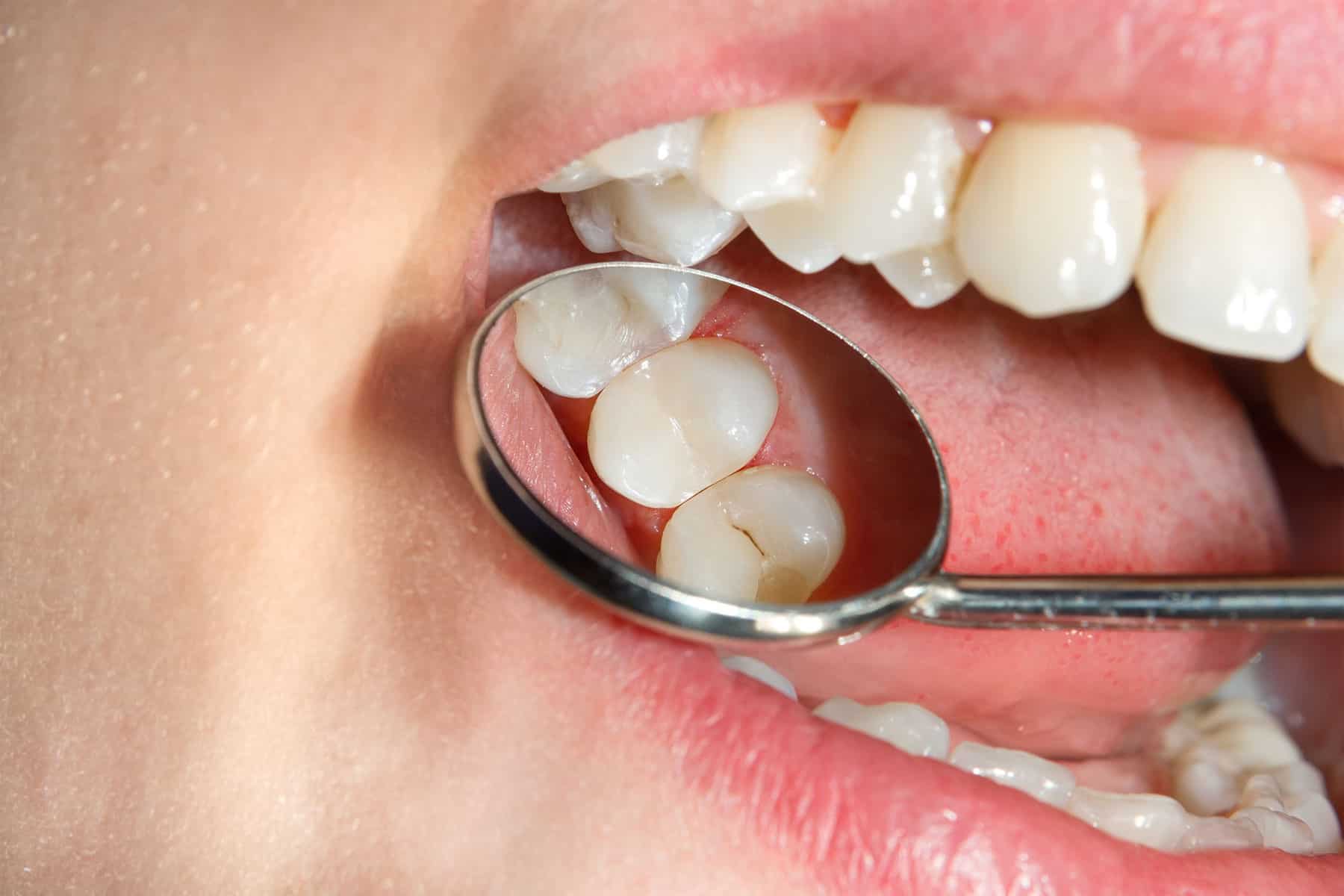 پوسیدگی دندان را در خانه درمان کنید