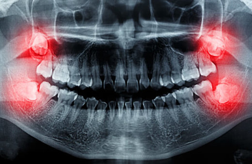 چرا دندان عقل همیشه کشیدنی نیست؟ 