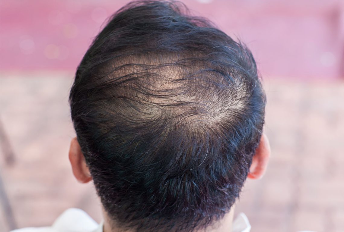 علت نازک شدن مو چیه؟