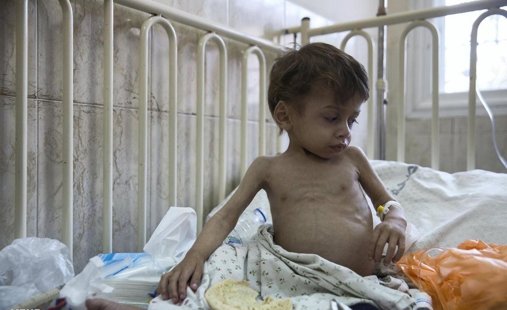 سوء تغذیه کودکان غزه‎ +تصاویر
