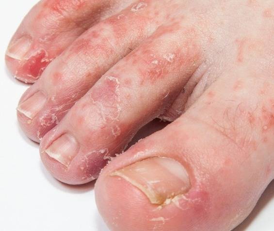 بیماری های ناخن پا به چه شکل است؟
