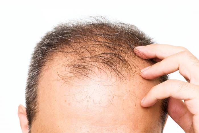 عوامل موثر بر ریزش مو
