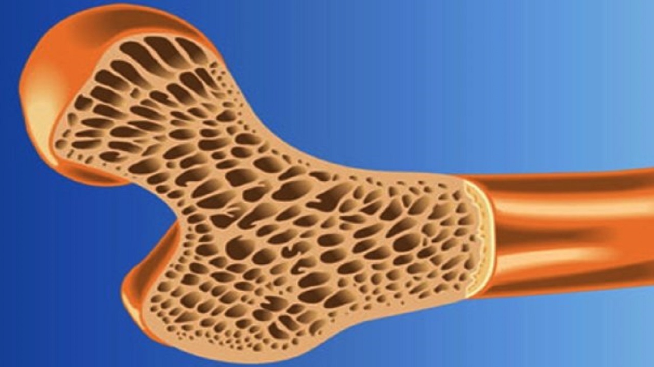 فناوری نانو به کمک درمان پوکی استخوان می آید