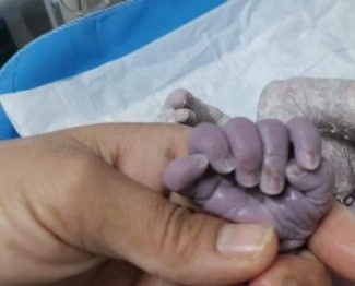 تولد نوزادی با ۲۴ انگشت! + عکس